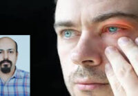 درمان خشکی چشم درمان خشکی چشم